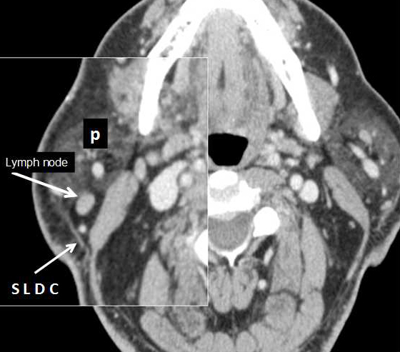 Ct Scan Showed Swollen Lymph Nodes In Neck Ct Scan Machine